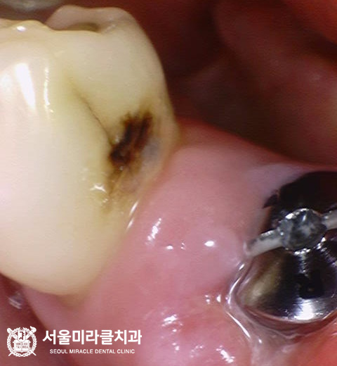 임플란트 주변에 음식물이 자주 끼는 이유와 치간 관리 방법 - 산본임플란트 - 서울미라클치과의원