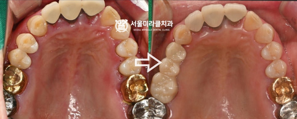 구강 사진 7