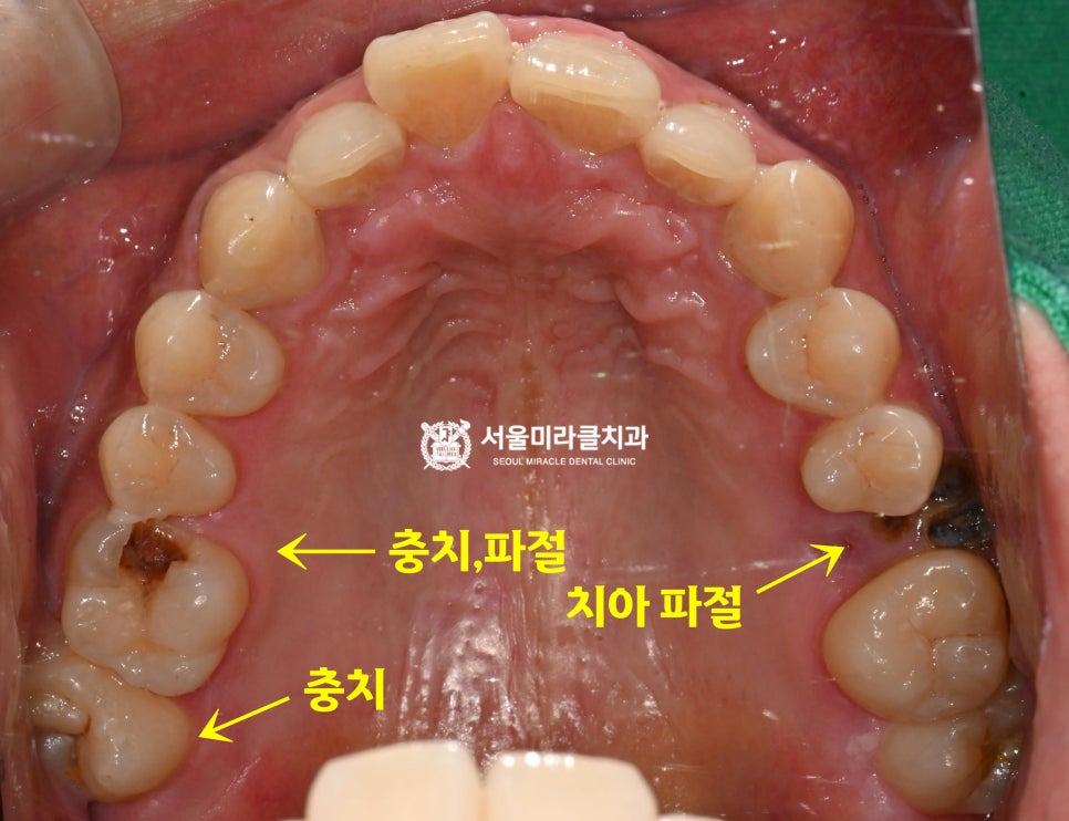 구강 사진 1