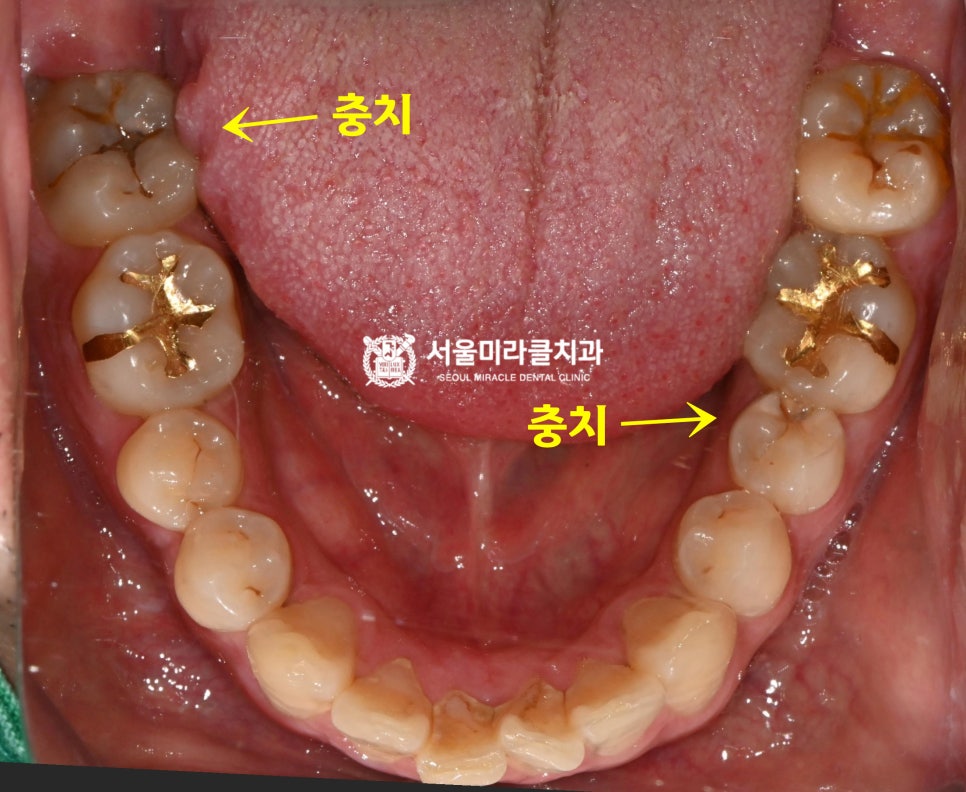구강 사진 2