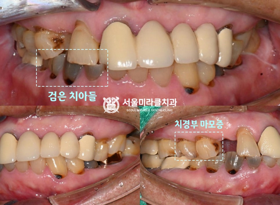 구강 사진 1