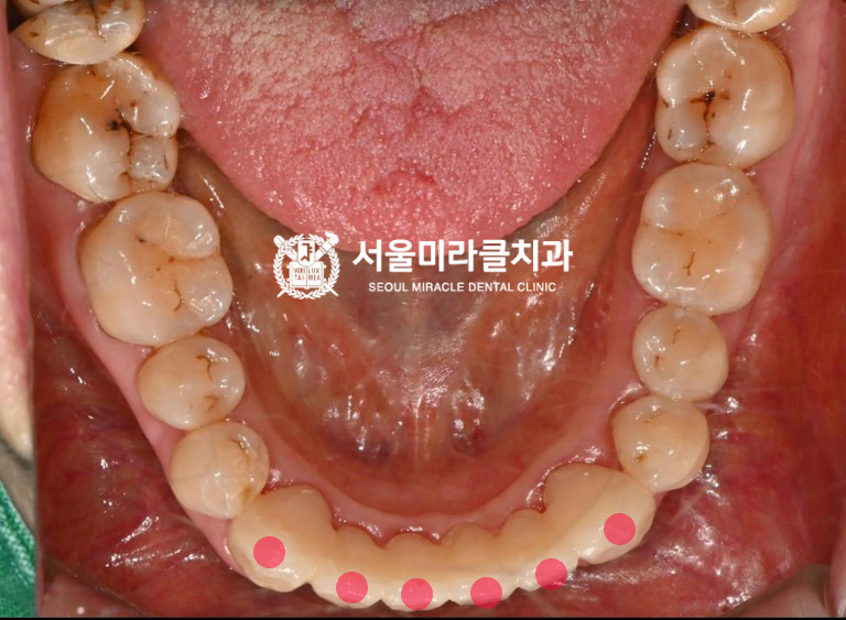 구강 사진 6