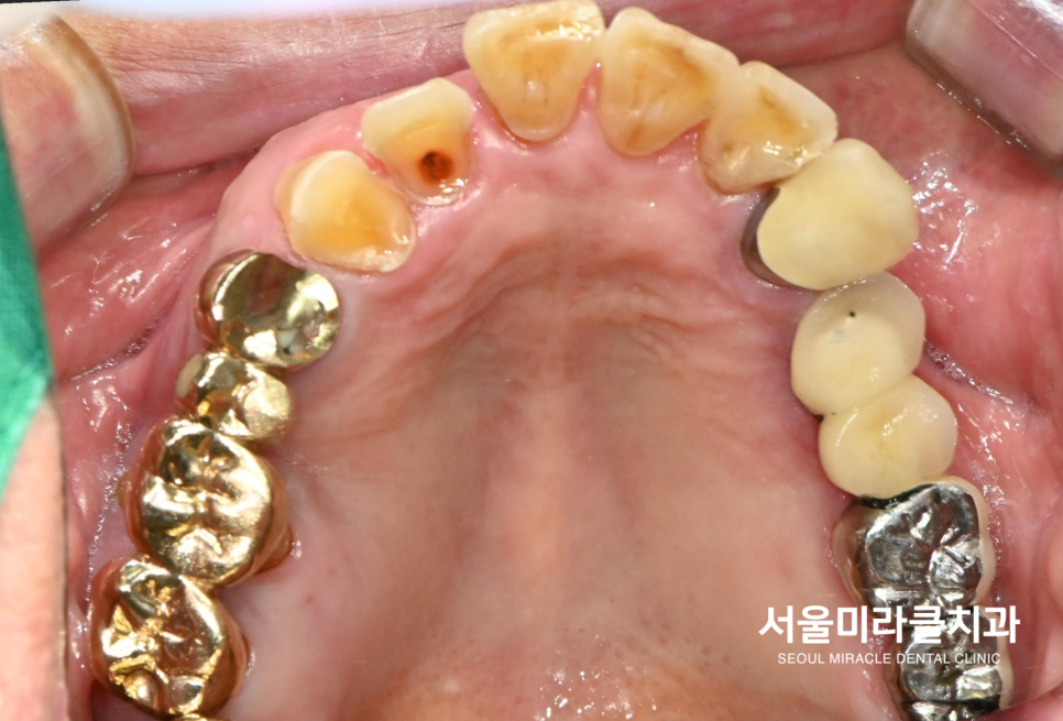 구강 사진 5