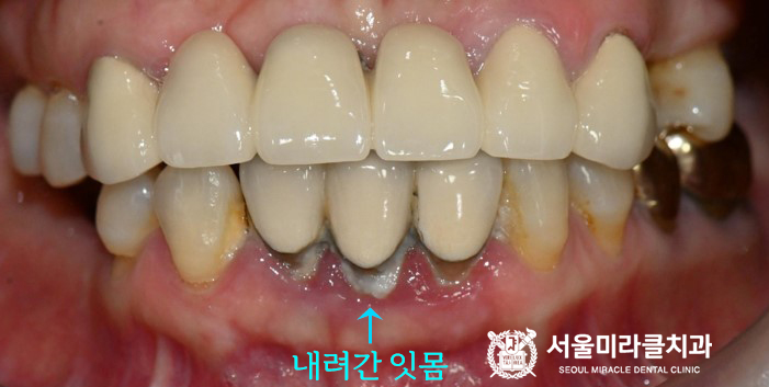 구강 사진 1