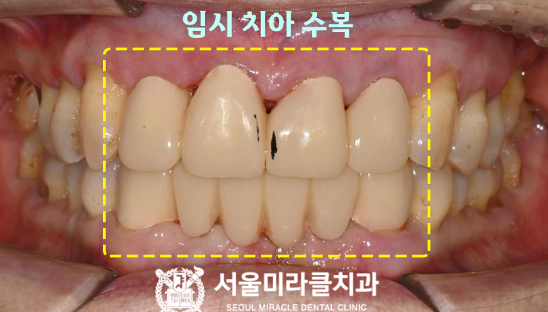 구강 사진 3