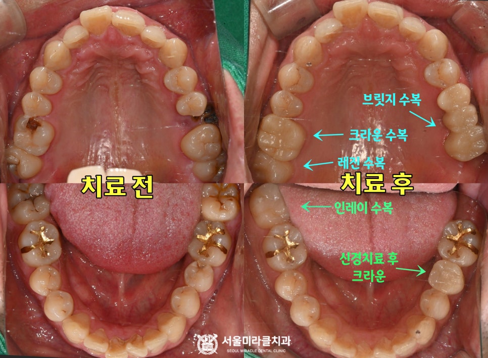 구강 사진 4