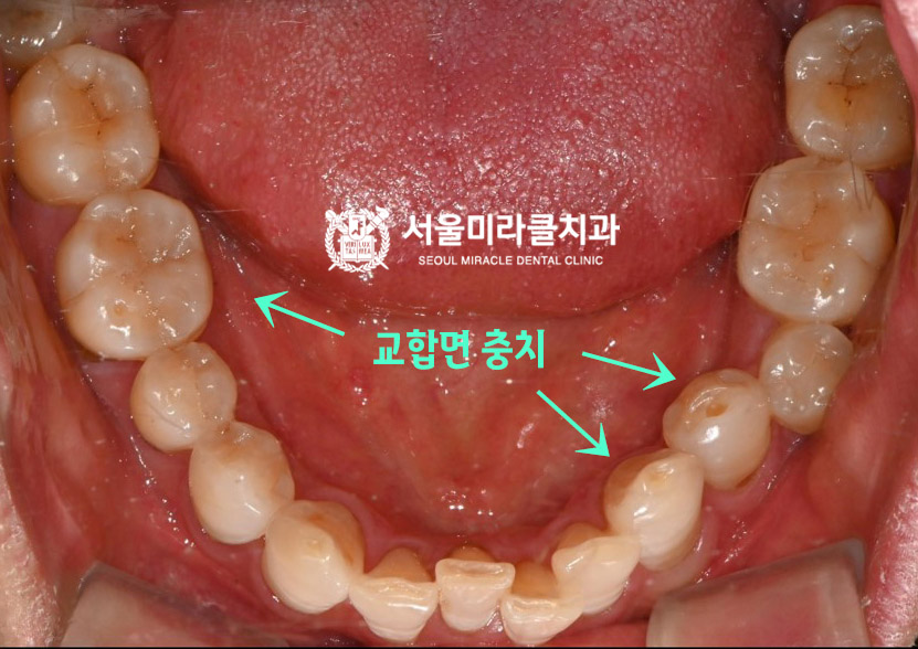 구강 사진 3