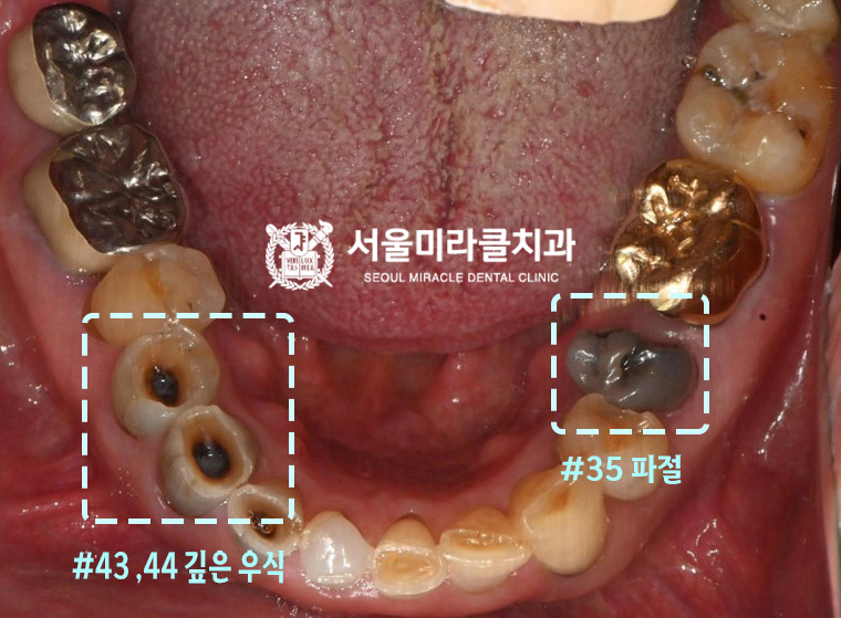 구강 사진 3