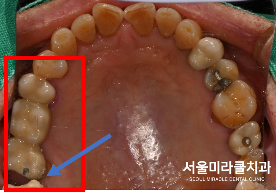 구강 사진 1
