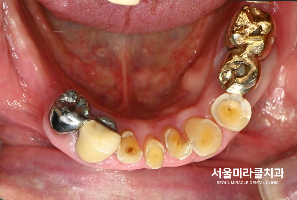 구강 사진 6