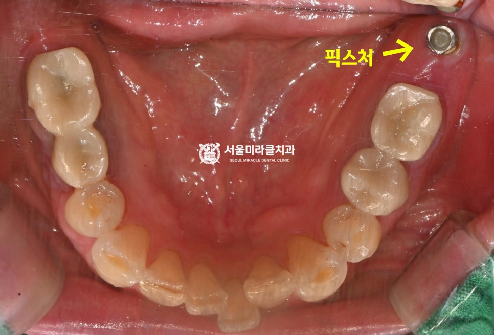 구강 사진 3