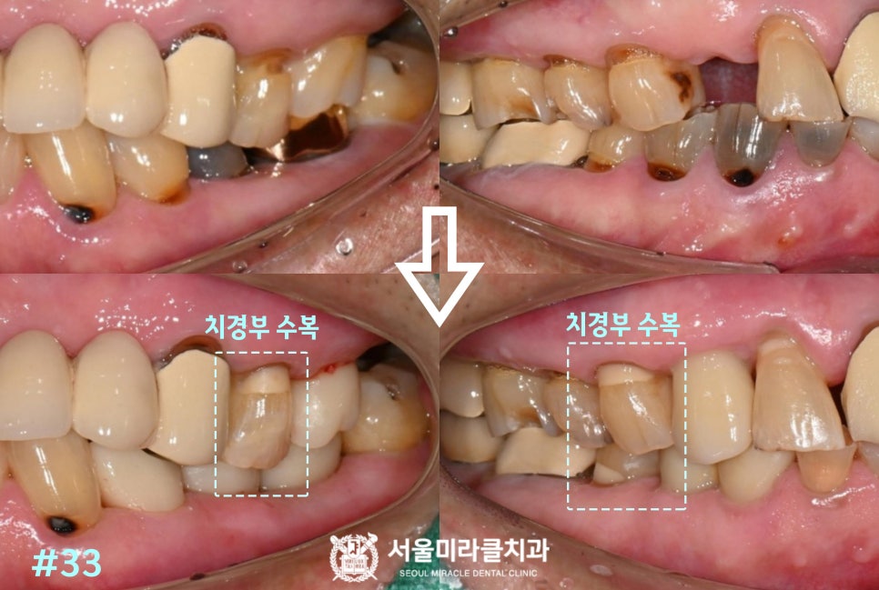 구강 사진 6