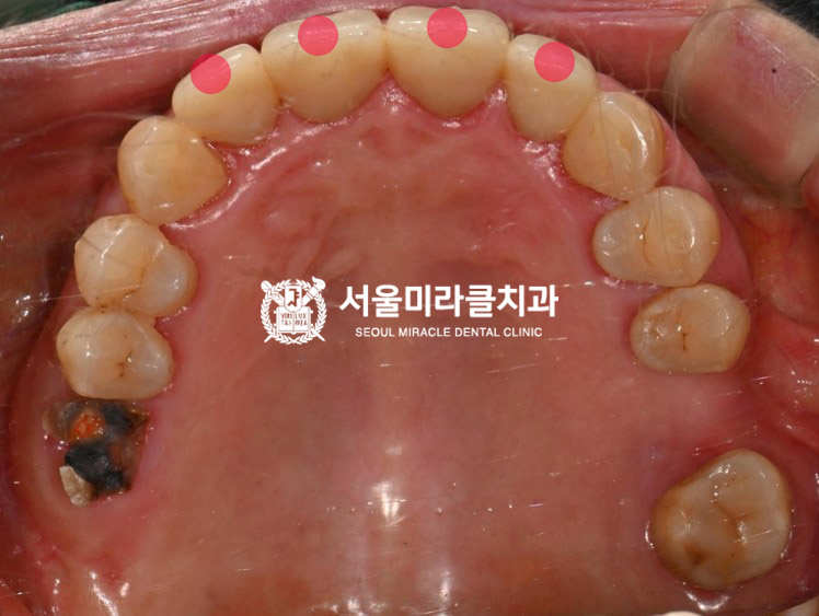 구강 사진 5