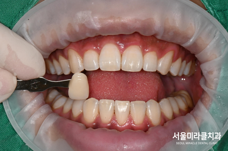 구강 사진 3