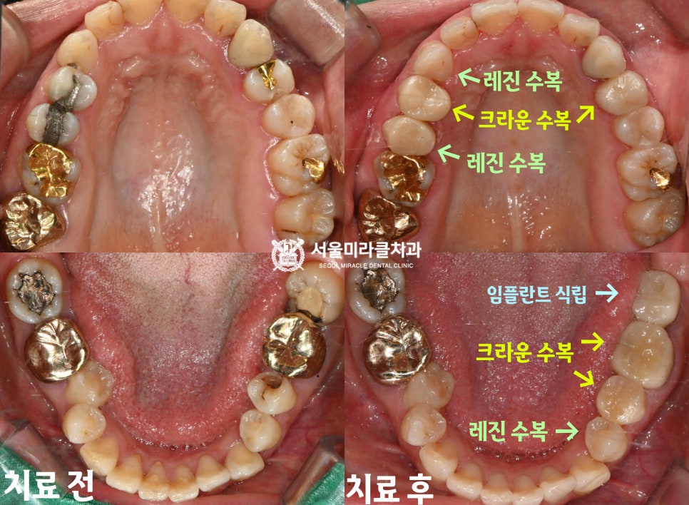 구강 사진 1