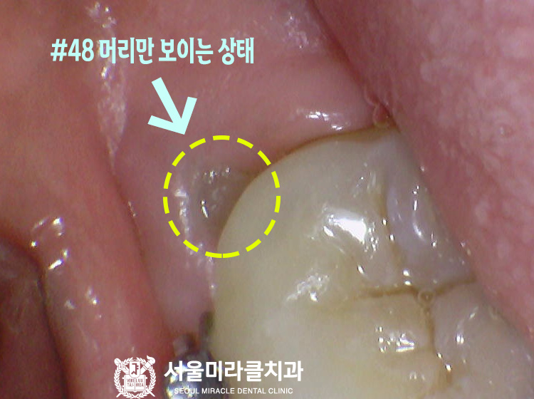 구강 사진 1