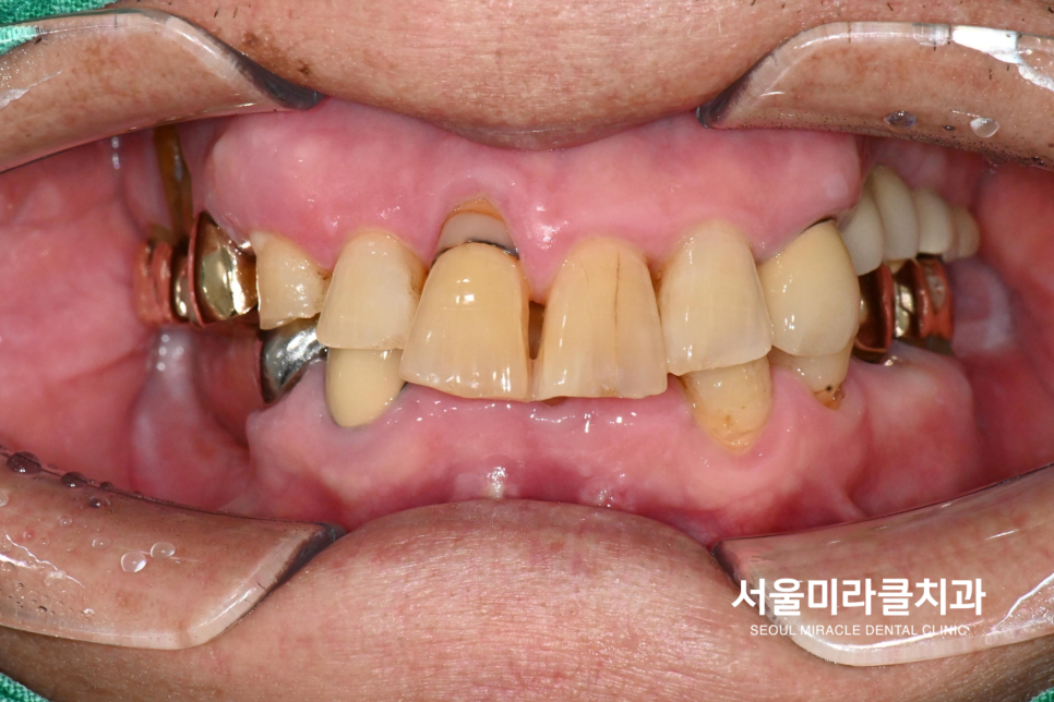 구강 사진 2