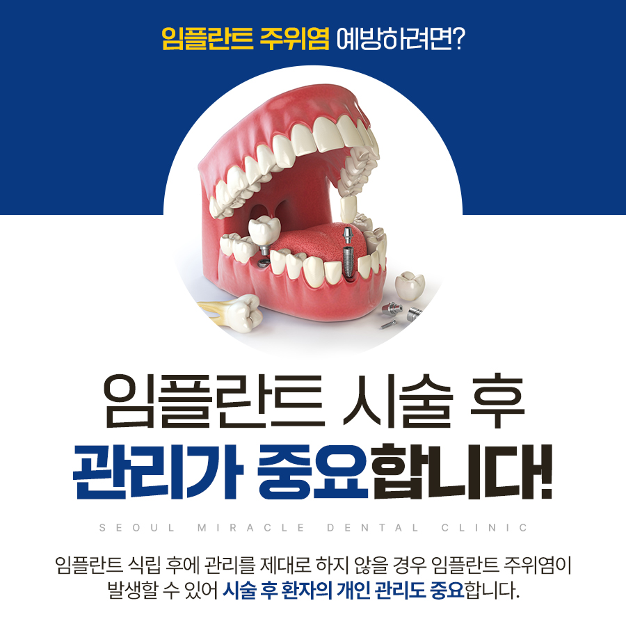 전체 임플란트 식립 개수는 무엇을 기준으로 정해지나요 — 산본전체임플란트