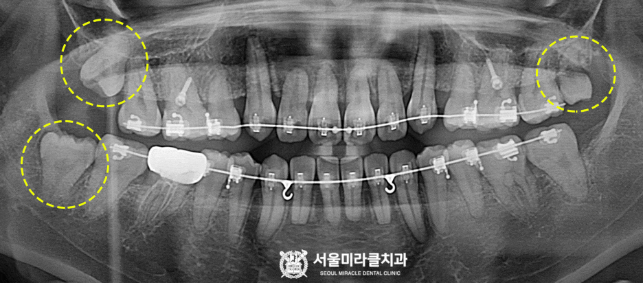 산본사랑니발치 위쪽과 아래쪽 사랑니는 난이도가 어떻게 다른가 — 서울미라클치과의원