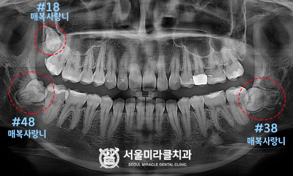 산본사랑니발치 후 식사와 양치는 어떻게 관리하는 것이 좋을까 — 서울미라클치과의원