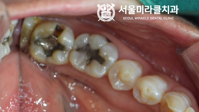 아말감