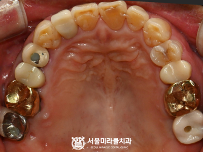 음식물끼임