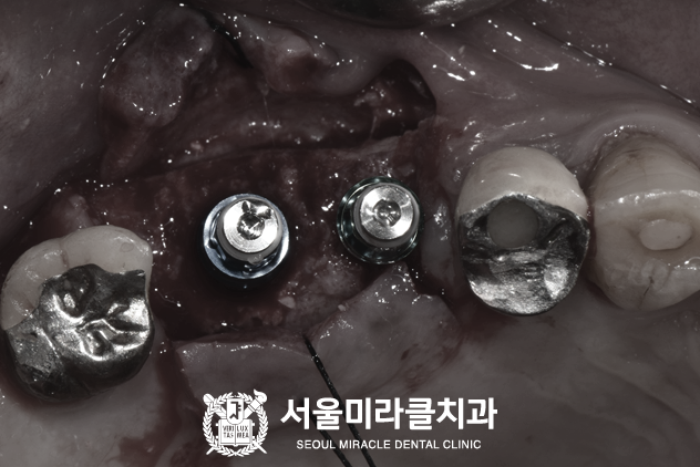 보관