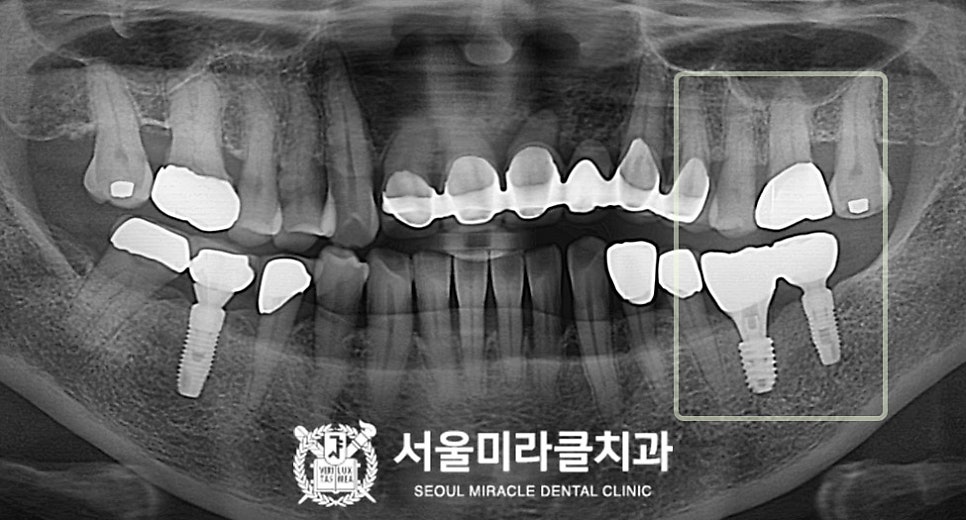 부분 영상 판독