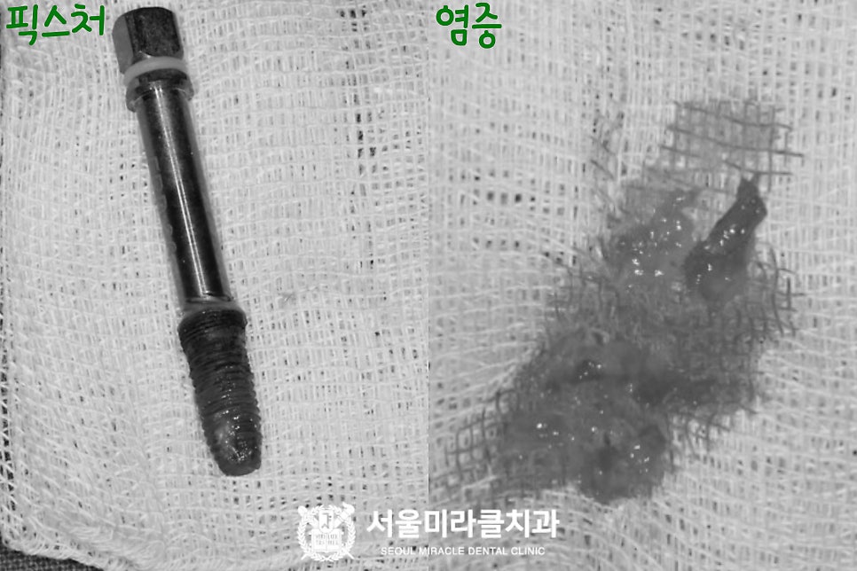 제거된 임플란트