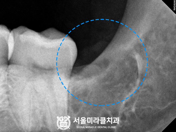 정밀 부위 확대