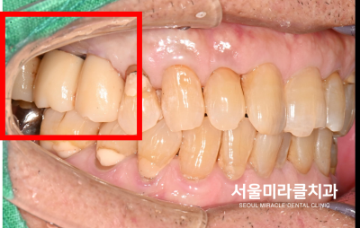 산본임플란트, 뼈 보강과 식립을 나누어 진행하는 경우 — 서울미라클치과의원