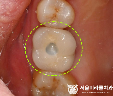 충전 부위 확인