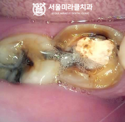 무통증