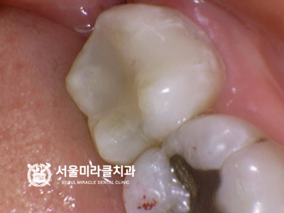 구강 상태