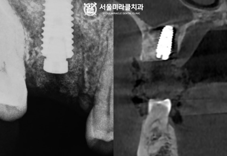 식립 각도 확인