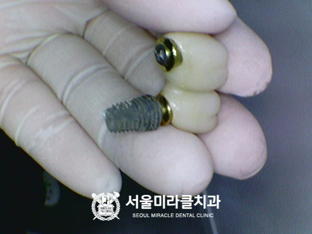 산본임플란트, 씌운 치아가 흔들릴 때 나사 문제인지 확인하려면 — 서울미라클치과의원