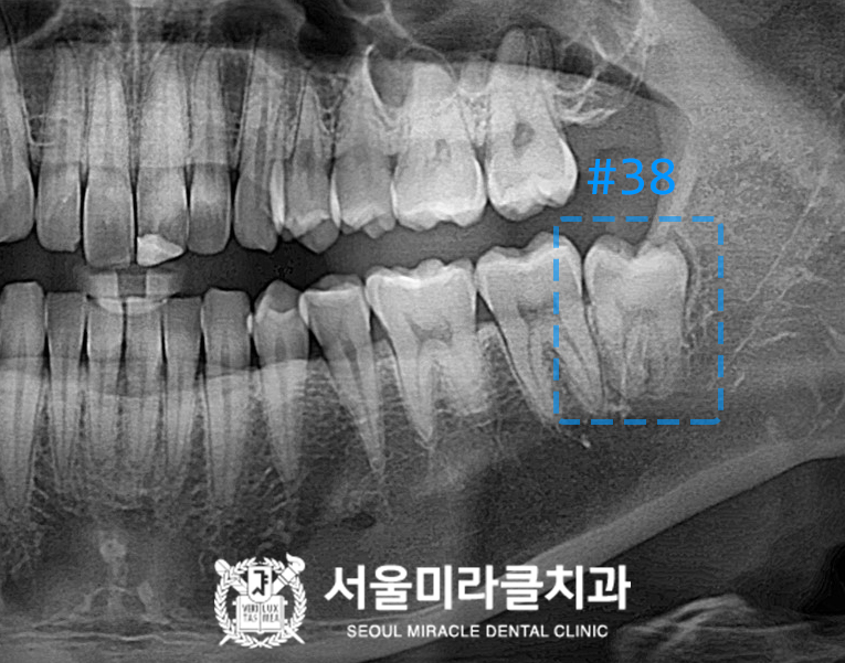 사랑니 위치 확인