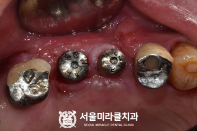 임시대처
