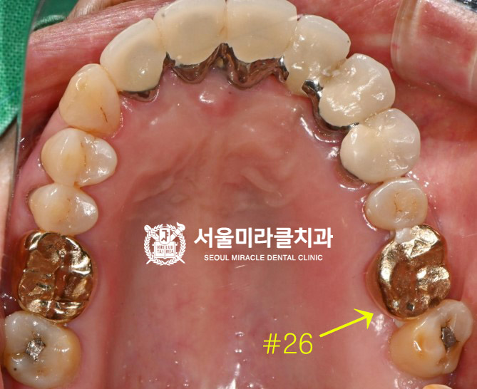 크라운 부위 확인