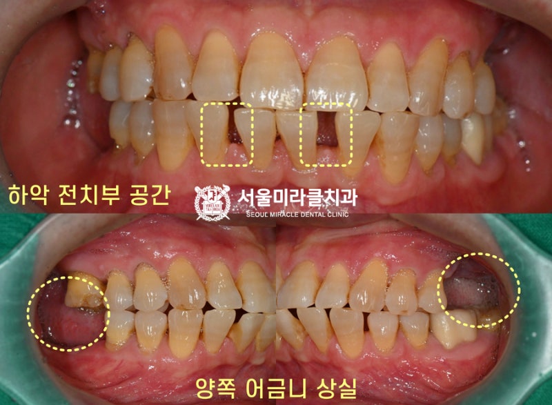 나사