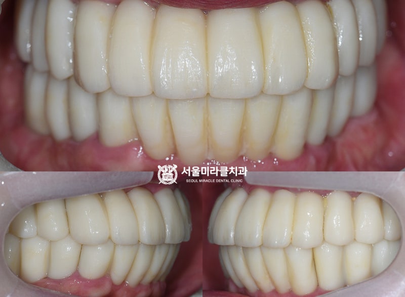 칫솔압력