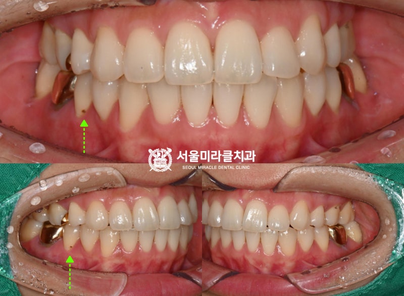 충전후