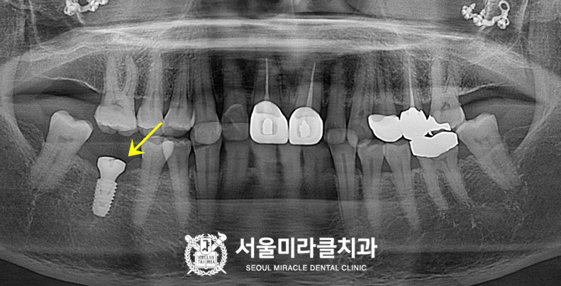 임플란트 식립 확인