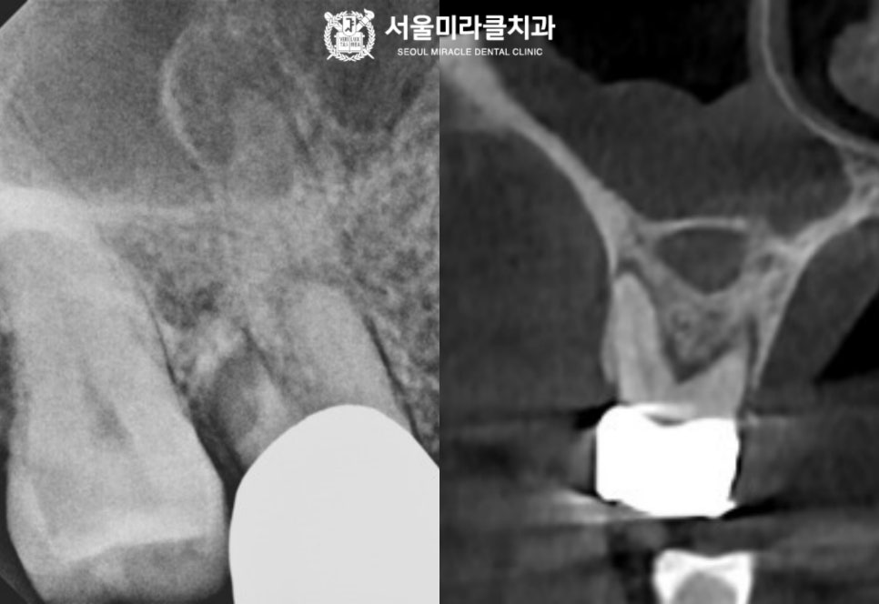 골 단면 비교