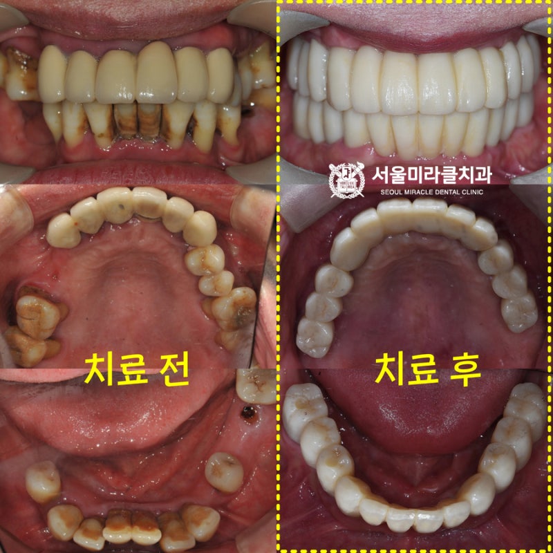 노출부위