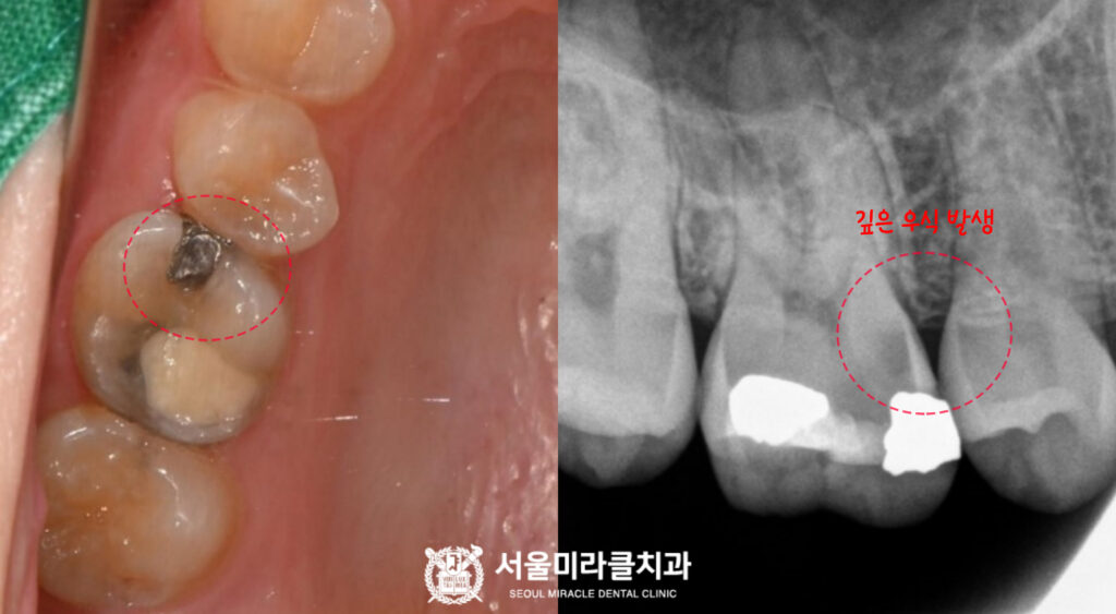 치아 균열 확인