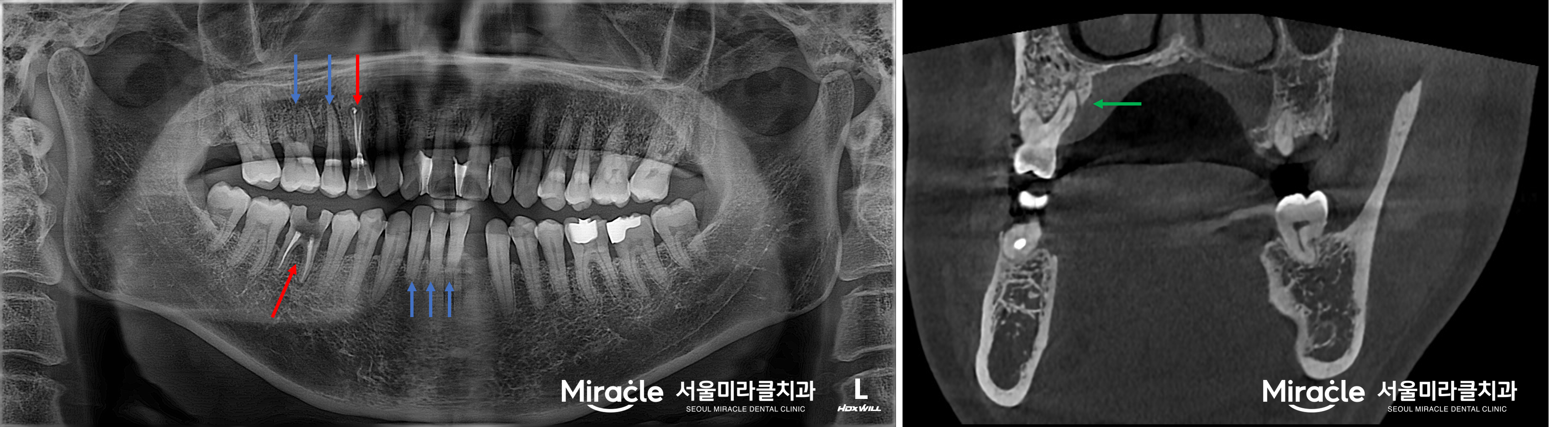 파노라마와 CT